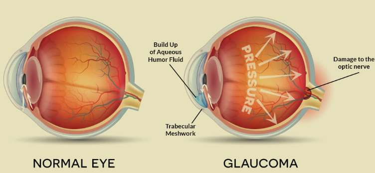Glaucoma